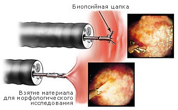 Биопсия