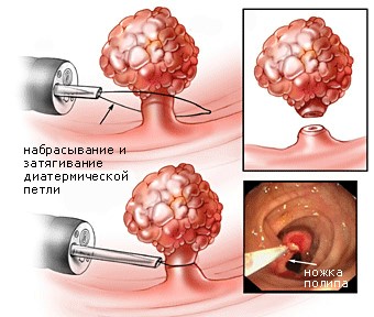 Полипы Полипы