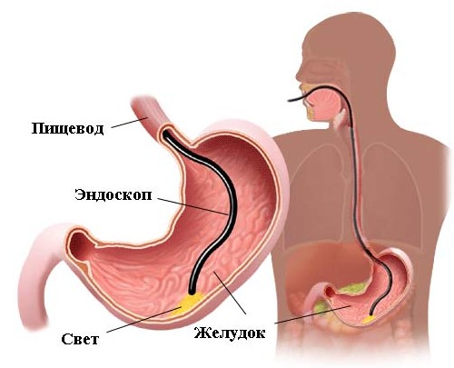 Гастроскопия Гастроскопия